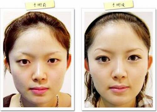韩式割双眼皮手术