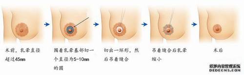 秀颜网 缩小乳头乳晕手术前后对比图