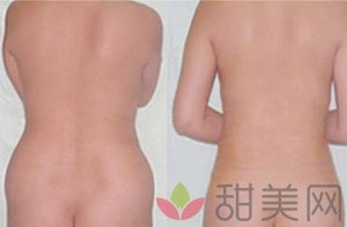 北京背部吸脂减肥手术多少钱